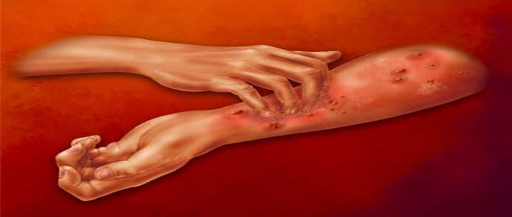 Μορφές κνίδωσης